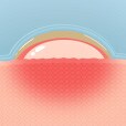 hydrocolloid bandage creating cushion graphic