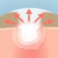 hydrocolloid bandage absorbing pus and oil graphic